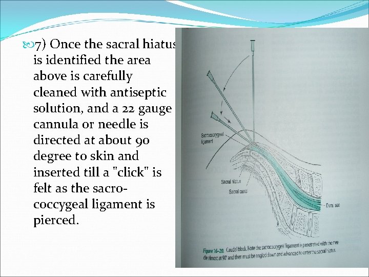  7) Once the sacral hiatus is identified the area above is carefully cleaned