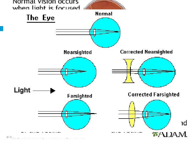 Vision Impairments Myopia (nearsighted) – impairment of distance vision Hyperopia (farsighted) – impairment of
