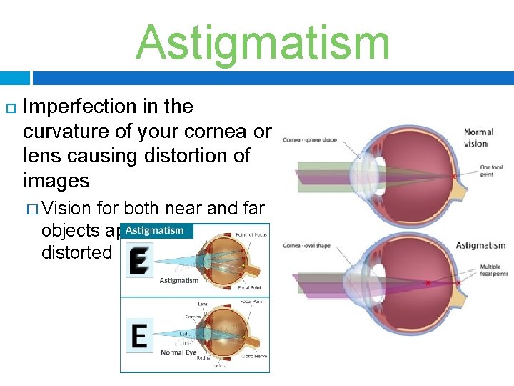 Astigmatism Imperfection in the curvature of your cornea or lens causing distortion of images