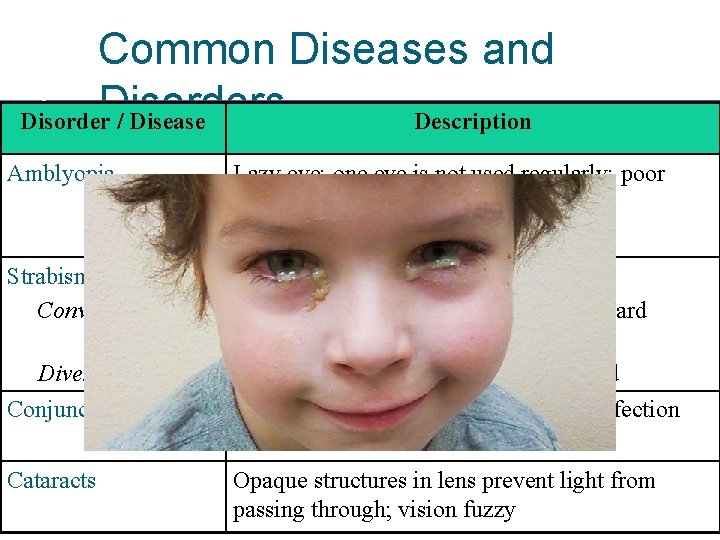 35 -47 Common Diseases and Disorders Disorder / Disease Description Amblyopia Lazy eye; one