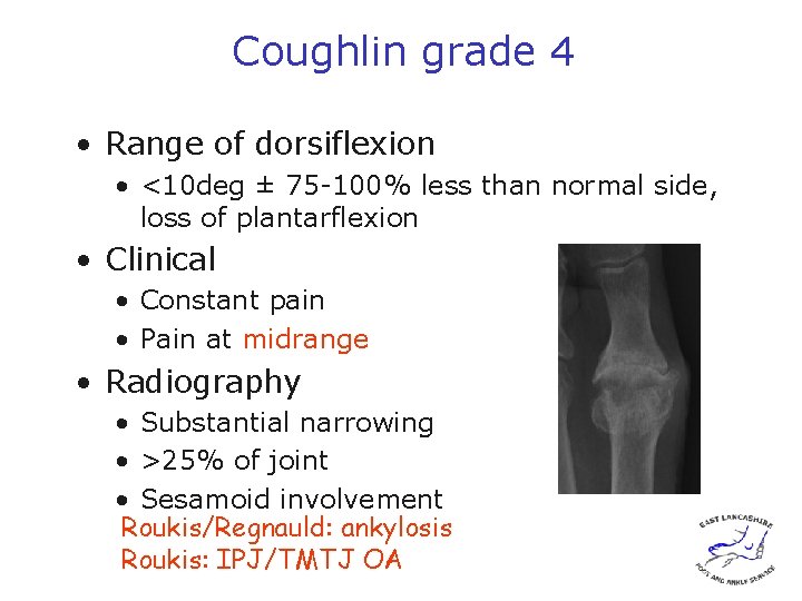 Coughlin grade 4 • Range of dorsiflexion • <10 deg ± 75 -100% less