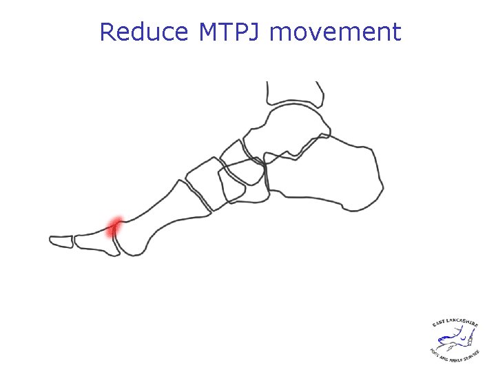 Reduce MTPJ movement 