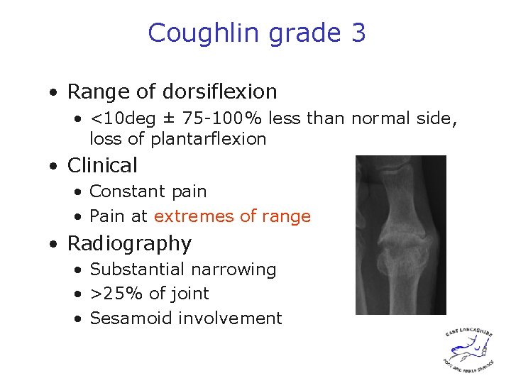 Coughlin grade 3 • Range of dorsiflexion • <10 deg ± 75 -100% less