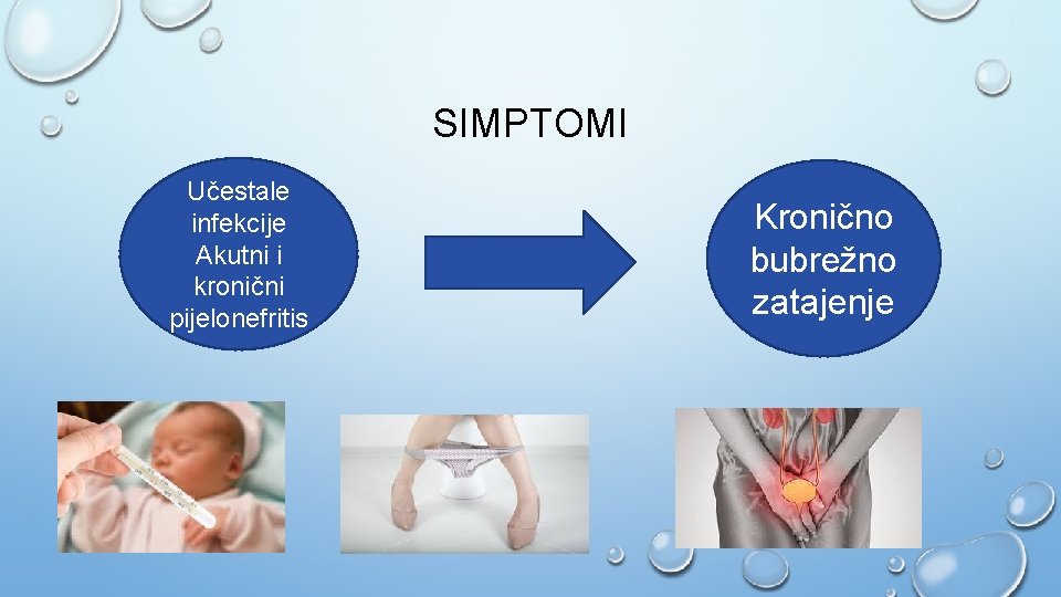 SIMPTOMI Učestale infekcije Akutni i kronični pijelonefritis Kronično bubrežno zatajenje 