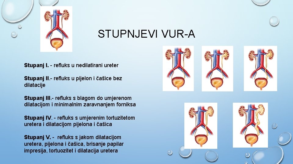 STUPNJEVI VUR-A Stupanj I. - refluks u nedilatirani ureter Stupanj II. - refluks u
