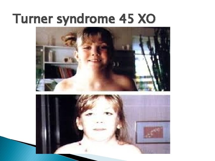 Turner syndrome 45 XO 