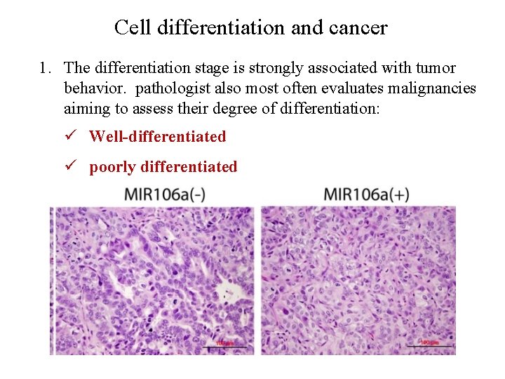 Cell differentiation and cancer 1. The differentiation stage is strongly associated with tumor behavior.