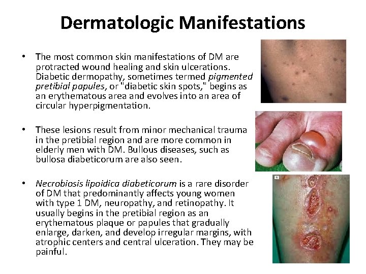 Dermatologic Manifestations • The most common skin manifestations of DM are protracted wound healing