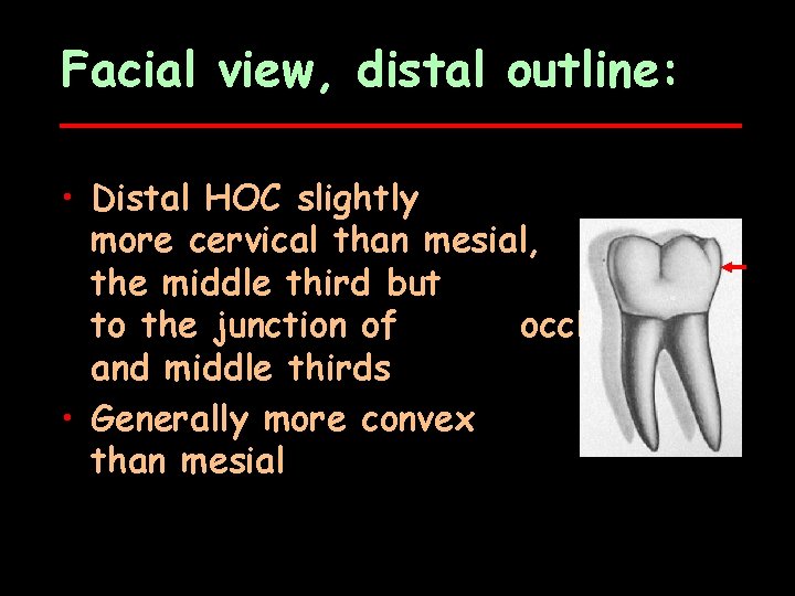 Facial view, distal outline: • Distal HOC slightly more cervical than mesial, in the