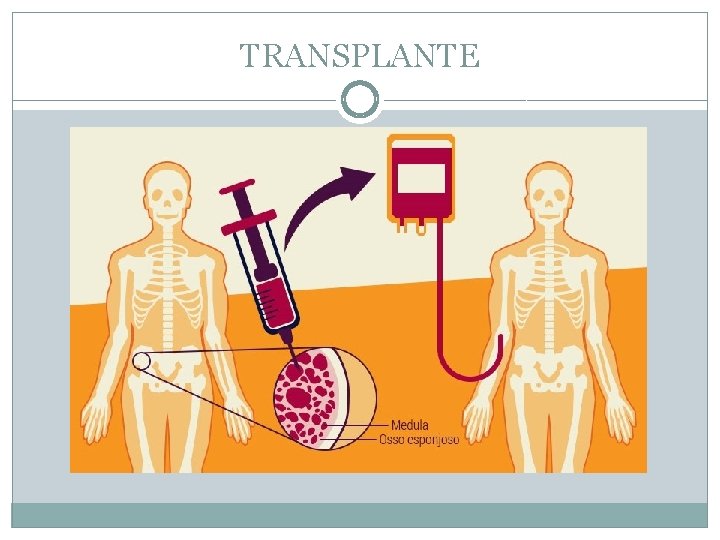 TRANSPLANTE 