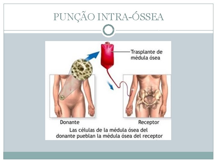 PUNÇÃO INTRA-ÓSSEA 