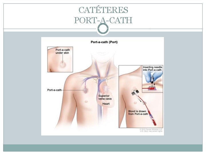 CATÉTERES PORT-A-CATH 