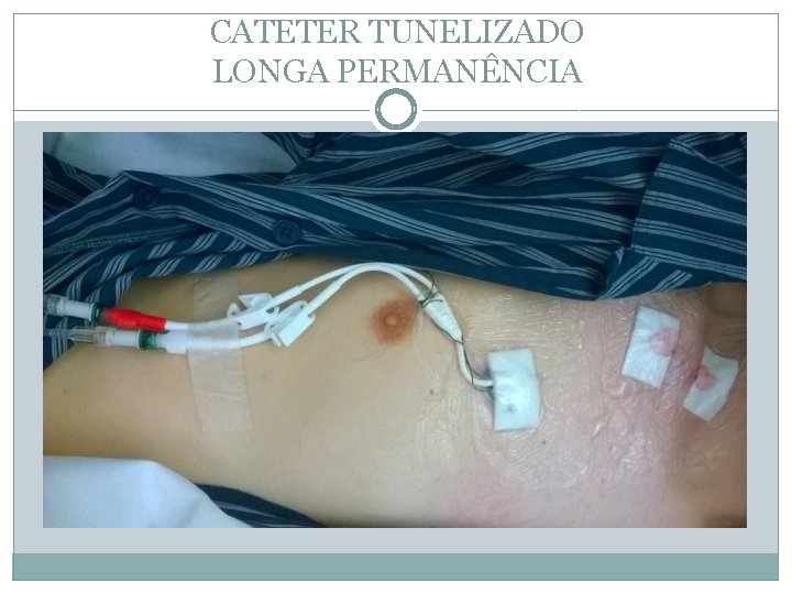 CATETER TUNELIZADO LONGA PERMANÊNCIA 