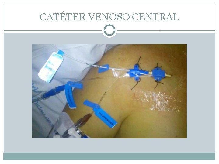 CATÉTER VENOSO CENTRAL 