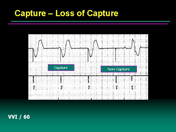 Capture – Loss of Capture VVI / 60 Non-Capture 