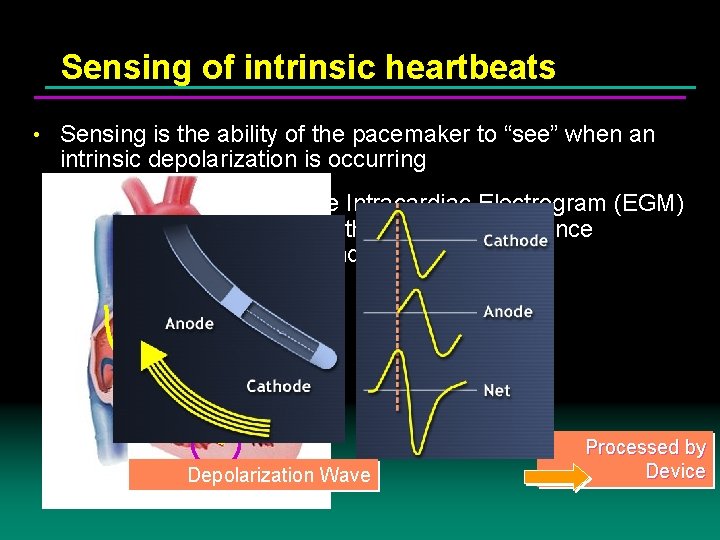Sensing of intrinsic heartbeats • Sensing is the ability of the pacemaker to “see”