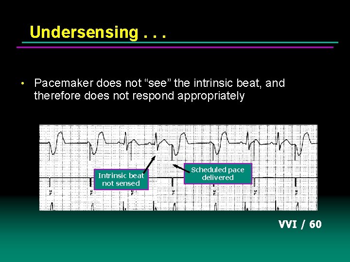 Undersensing. . . • Pacemaker does not “see” the intrinsic beat, and therefore does