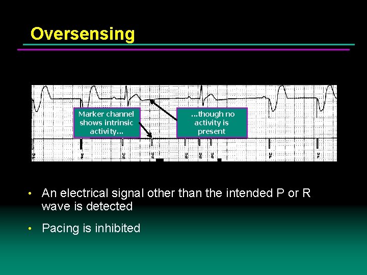 Oversensing Marker channel shows intrinsic activity. . . though no activity is present •