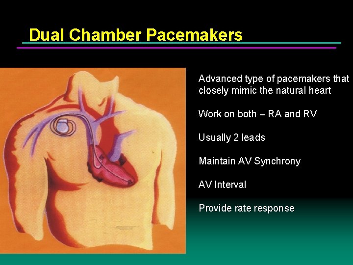 Dual Chamber Pacemakers Advanced type of pacemakers that closely mimic the natural heart Work