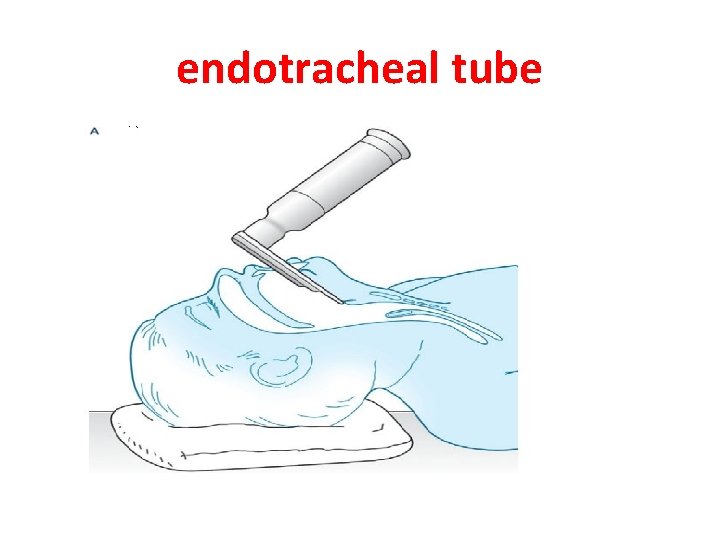 endotracheal tube 