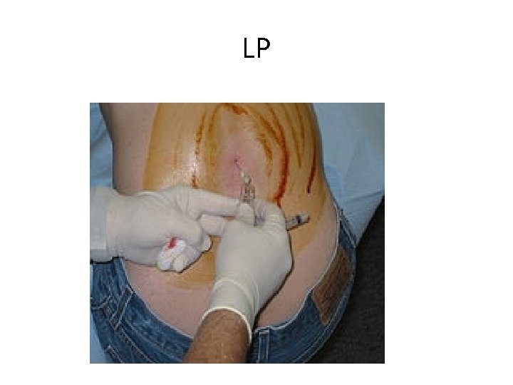 LP 