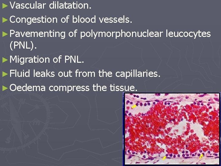 ► Vascular dilatation. ► Congestion of blood vessels. ► Pavementing of polymorphonuclear leucocytes (PNL).