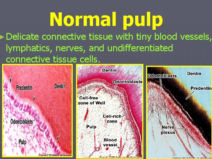 ► Delicate Normal pulp connective tissue with tiny blood vessels, lymphatics, nerves, and undifferentiated