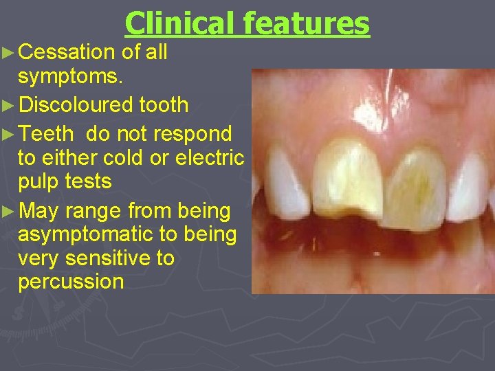 Clinical features ► Cessation of all symptoms. ► Discoloured tooth ► Teeth do not
