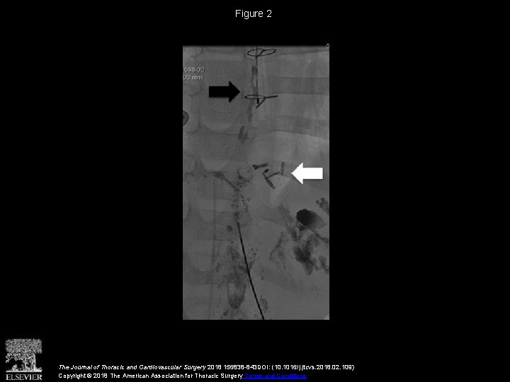 Figure 2 The Journal of Thoracic and Cardiovascular Surgery 2018 156838 -843 DOI: (10.