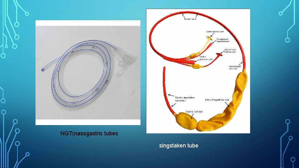 NGT(nasogastric tubes singstaken tube 