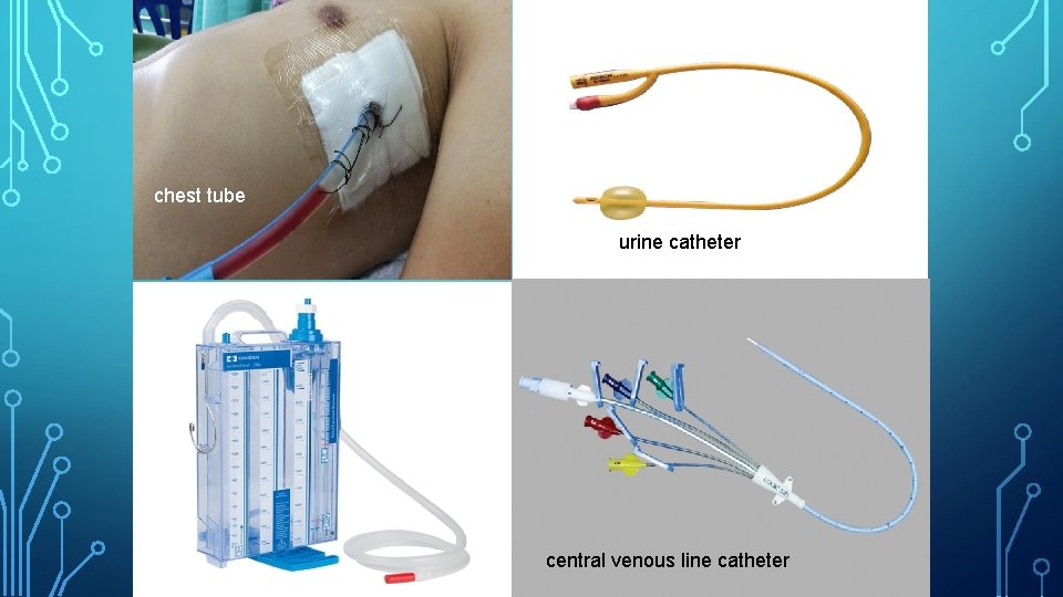 chest tube urine catheter central venous line catheter 