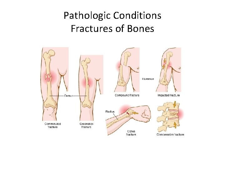 Pathologic Conditions Fractures of Bones 