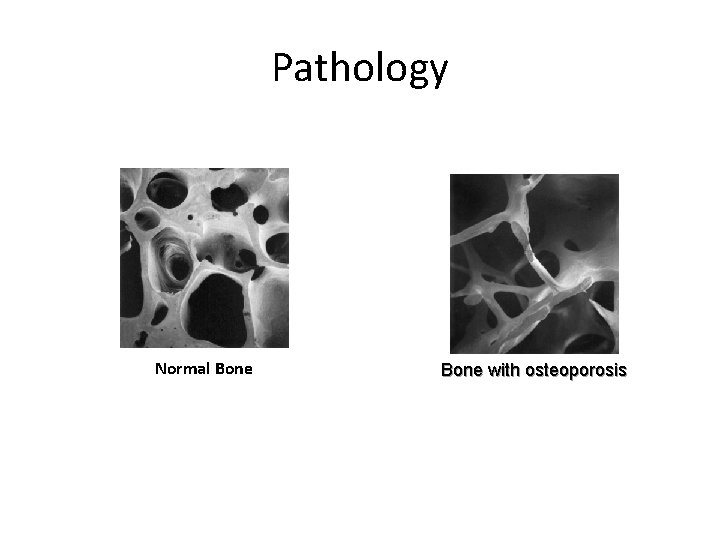 Pathology Normal Bone with osteoporosis 