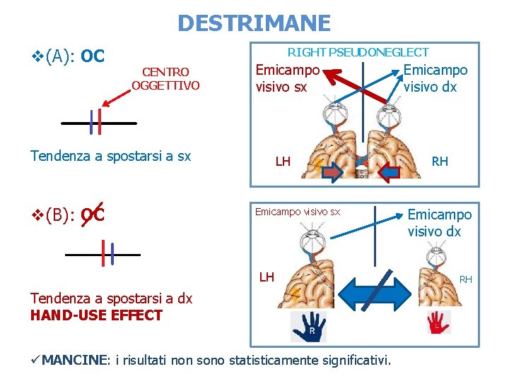 DESTRIMANE v(A): OC RIGHT PSEUDONEGLECT CENTRO OGGETTIVO Emicampo visivo sx Tendenza a spostarsi a