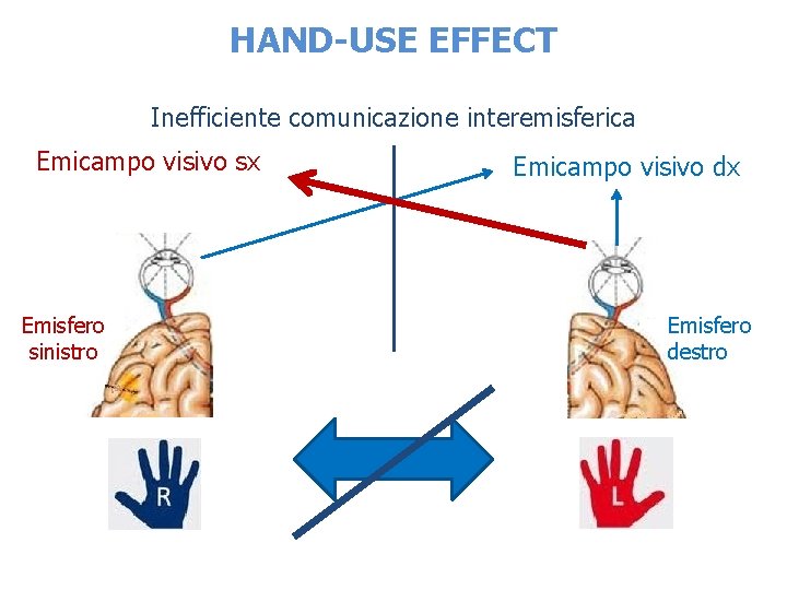 HAND-USE EFFECT Inefficiente comunicazione interemisferica Emicampo visivo sx Emisfero sinistro Emicampo visivo dx Emisfero