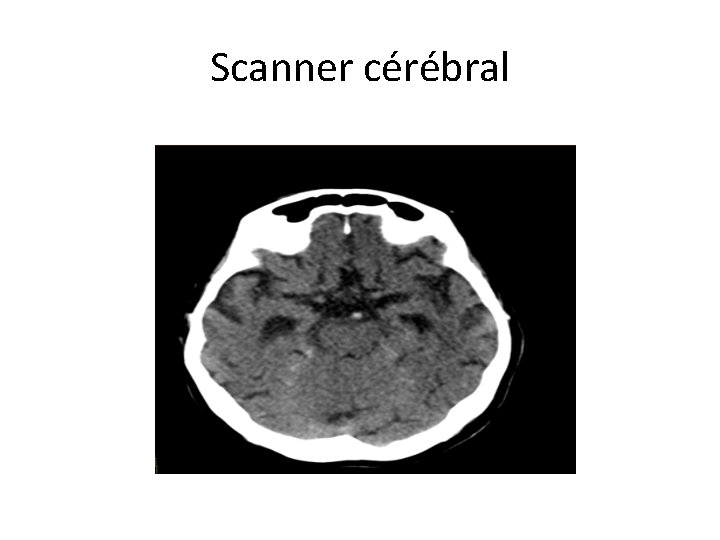 Scanner cérébral 