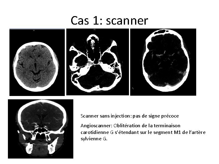 Cas 1: scanner Scanner sans injection: pas de signe précoce Angioscanner: Oblitération de la