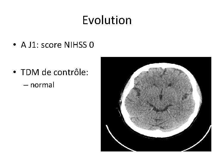 Evolution • A J 1: score NIHSS 0 • TDM de contrôle: – normal