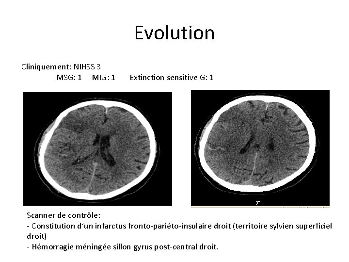 Evolution Cliniquement: NIHSS 3 MSG: 1 MIG: 1 Extinction sensitive G: 1 Scanner de