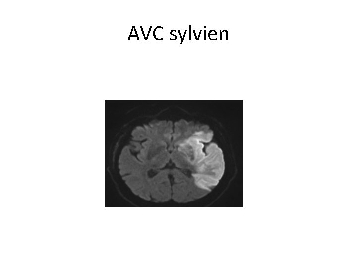 AVC sylvien 