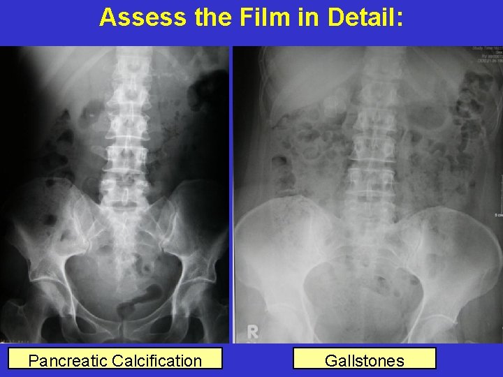 Assess the Film in Detail: Pancreatic Calcification Gallstones 