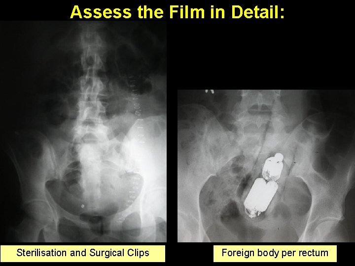 Assess the Film in Detail: Sterilisation and Surgical Clips Foreign body per rectum 