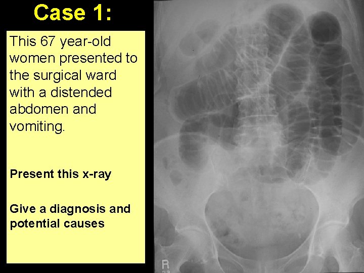 Case 1: This 67 year-old women presented to the surgical ward with a distended