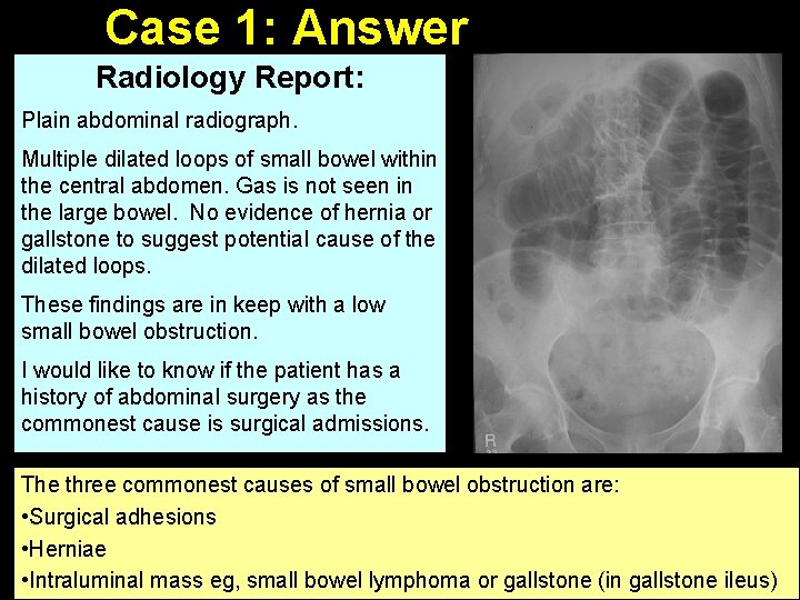 Case 1: Answer Radiology Report: Plain abdominal radiograph. Multiple dilated loops of small bowel