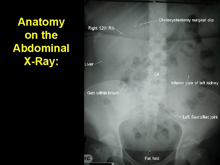 Anatomy on the Abdominal X-Ray: 