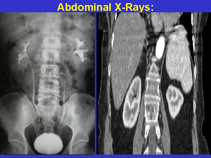 Abdominal X-Rays: AXR-1 AXR-2 