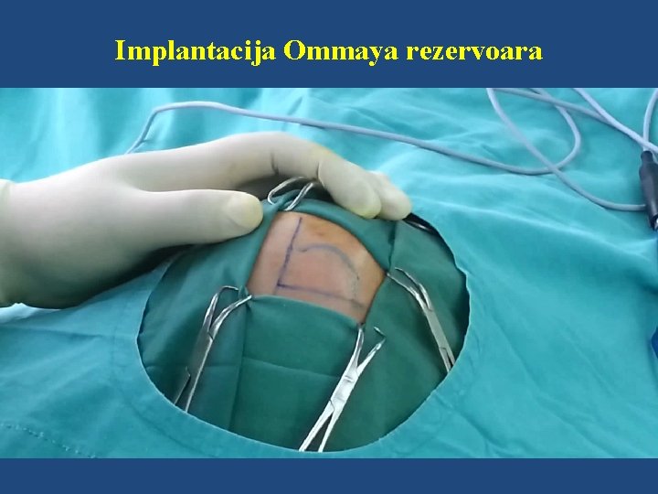 Implantacija Ommaya rezervoara 