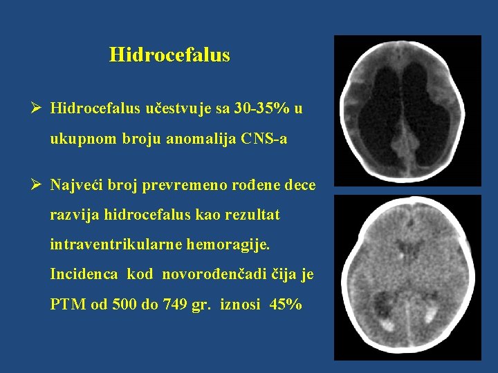 Hidrocefalus Ø Hidrocefalus učestvuje sa 30 -35% u ukupnom broju anomalija CNS-a Ø Najveći