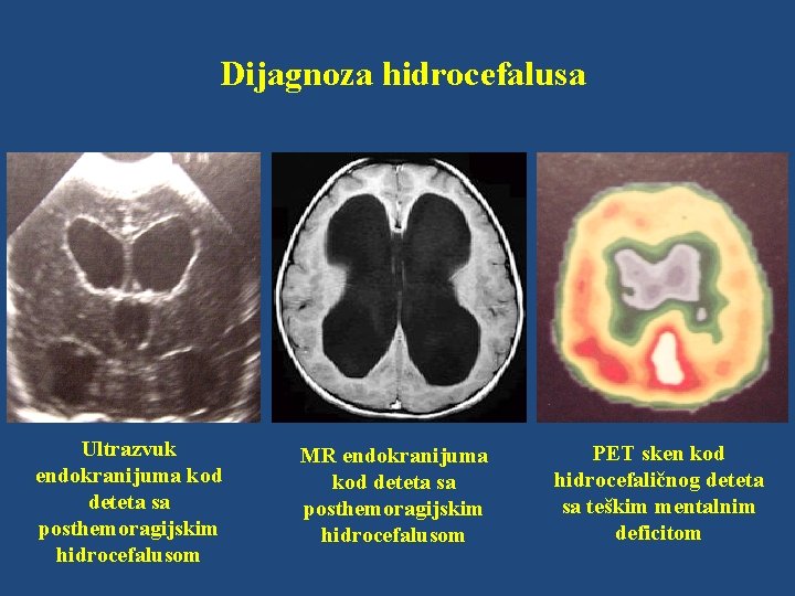 Dijagnoza hidrocefalusa Ultrazvuk endokranijuma kod deteta sa posthemoragijskim hidrocefalusom MR endokranijuma kod deteta sa