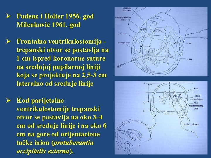 Ø Pudenz i Holter 1956. god Milenković 1961. god Ø Frontalna ventrikulostomija trepanski otvor